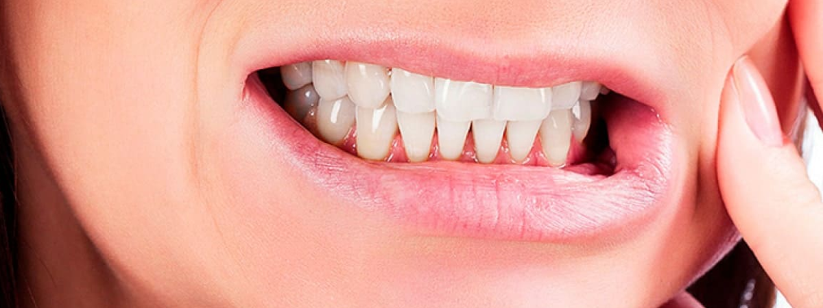 bruxism-teeth-grinding