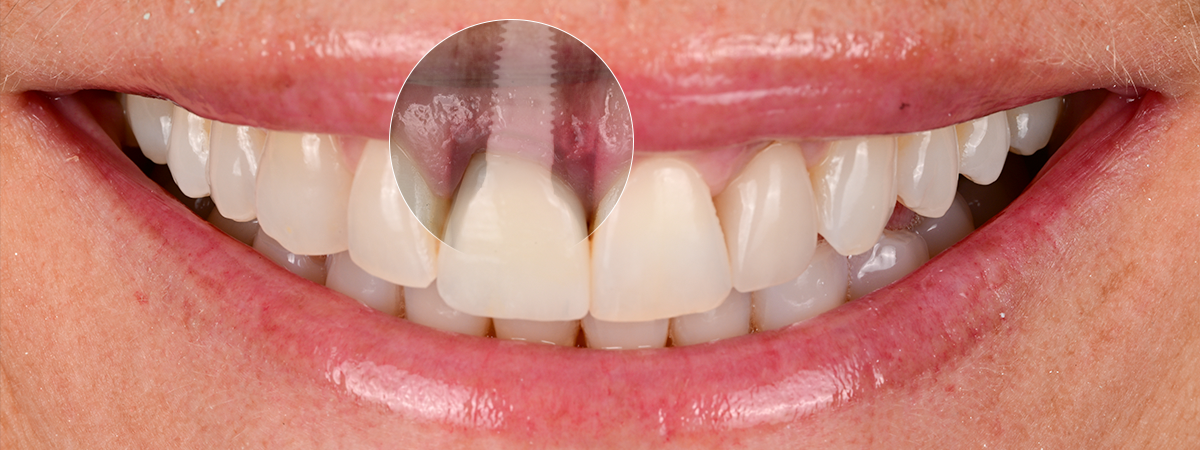 dental-implant-dubai