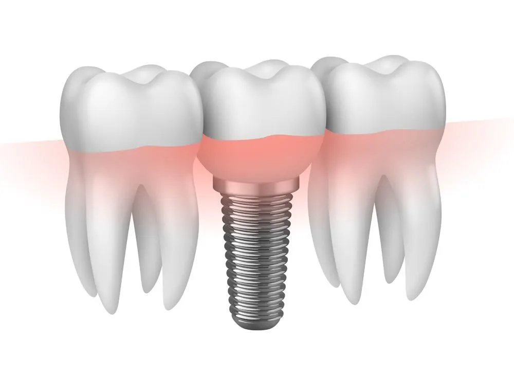 dental-implant-dubai