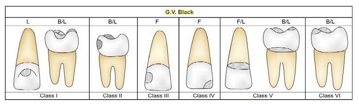 G.V Black Dental Caried Classifications