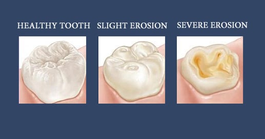 dental erosion