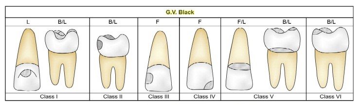 G.V Black Dental Caried Classifications