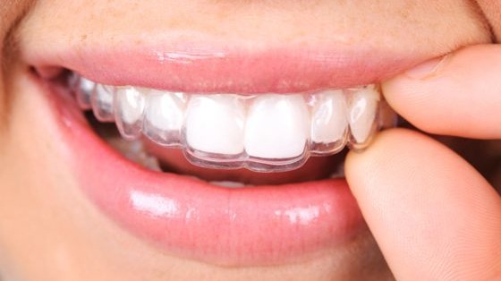 Invisalign