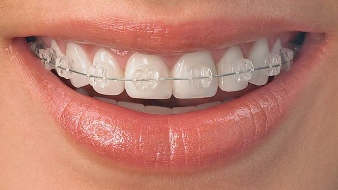 Ceramic Braces