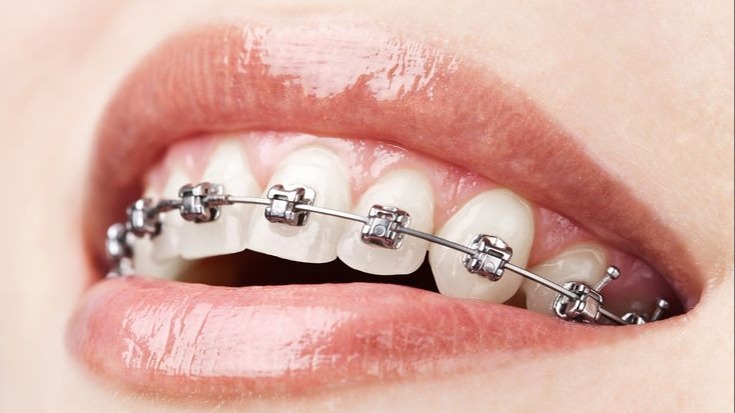 Metal Braces 