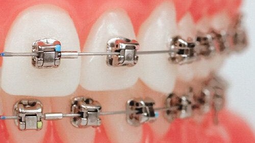 Damon Braces