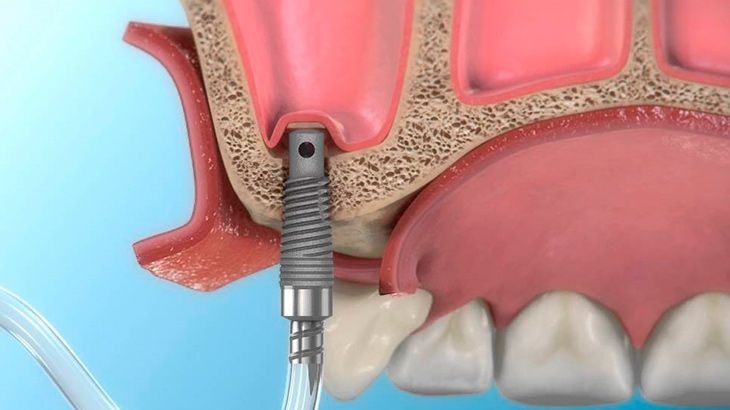 Sinus Lift