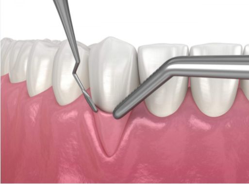 Soft Tissue Graft