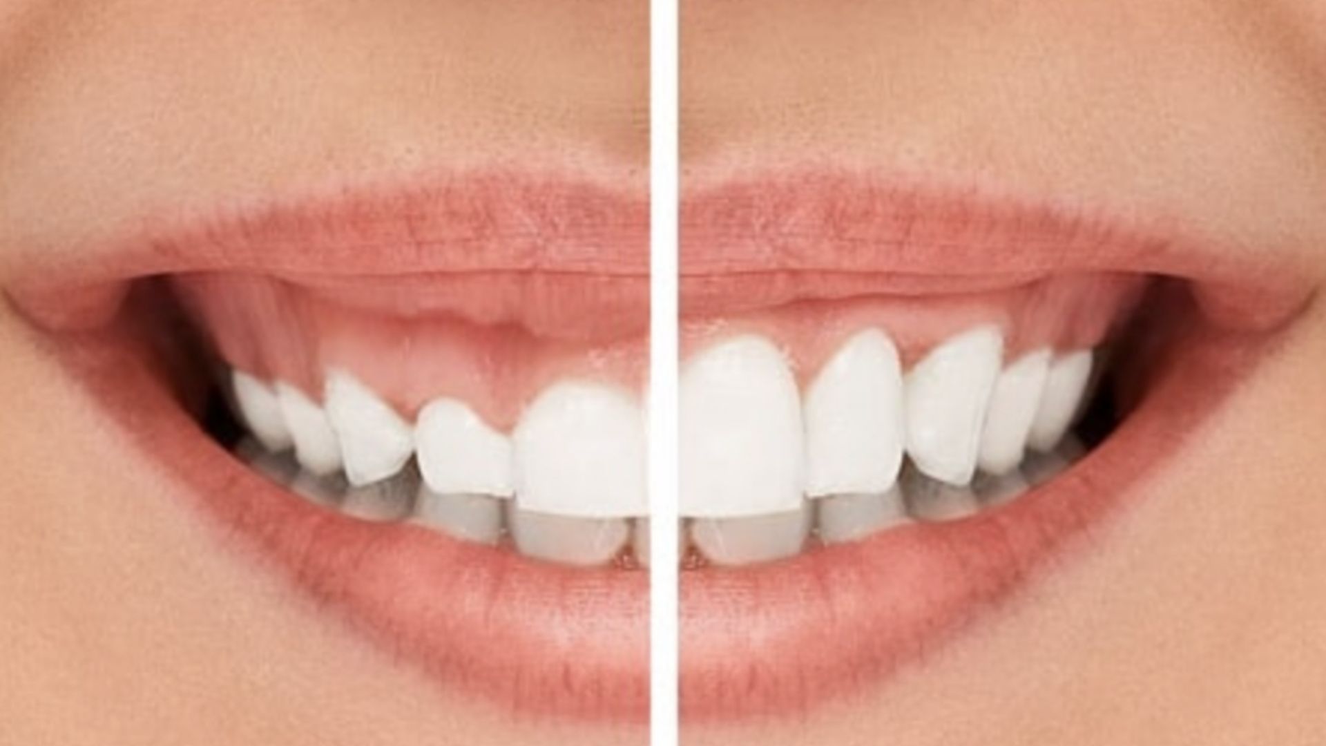 Cosmetic Gum Surgery