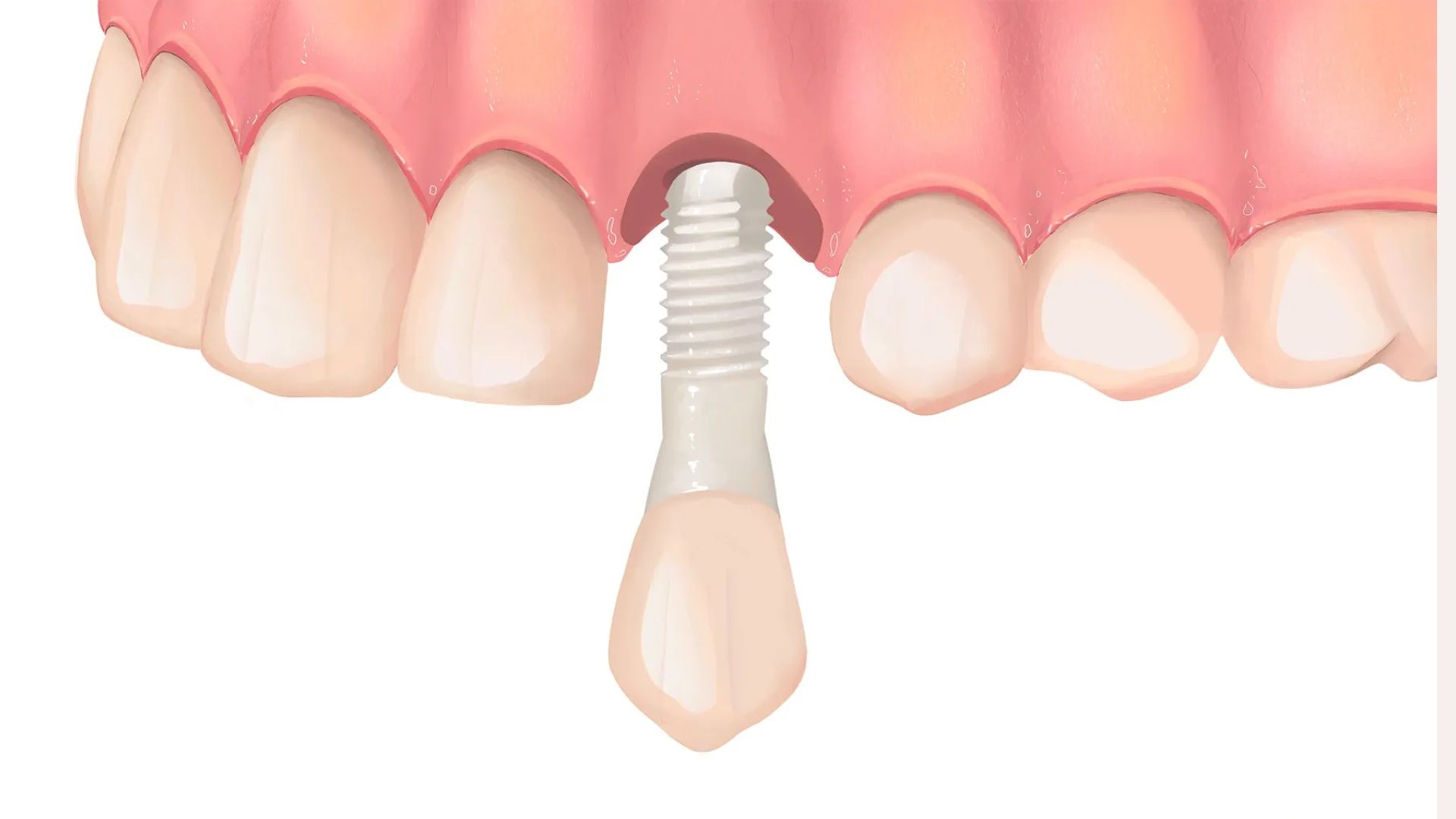 Ceramic Implants