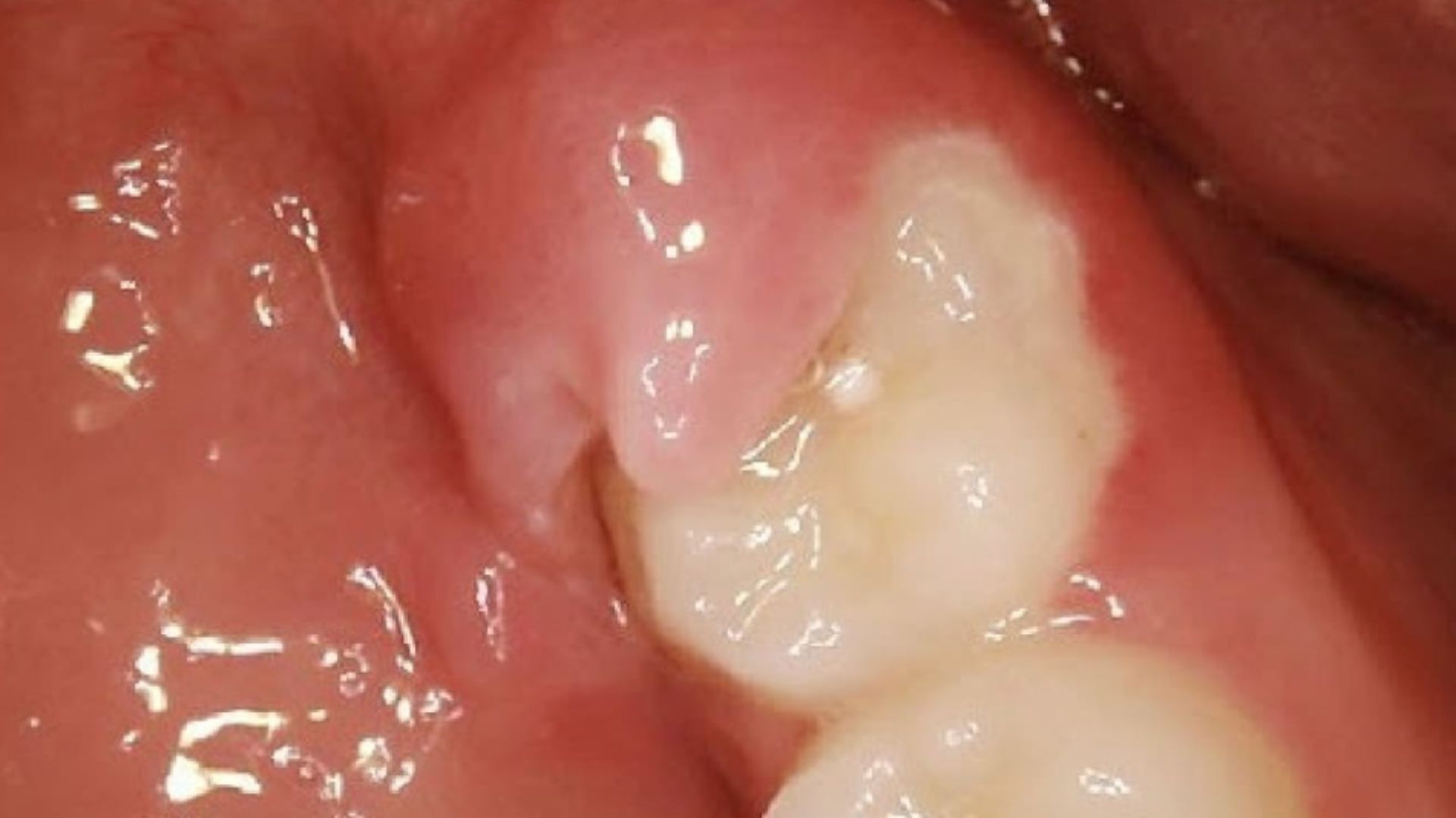 Pericoronitis Treatment